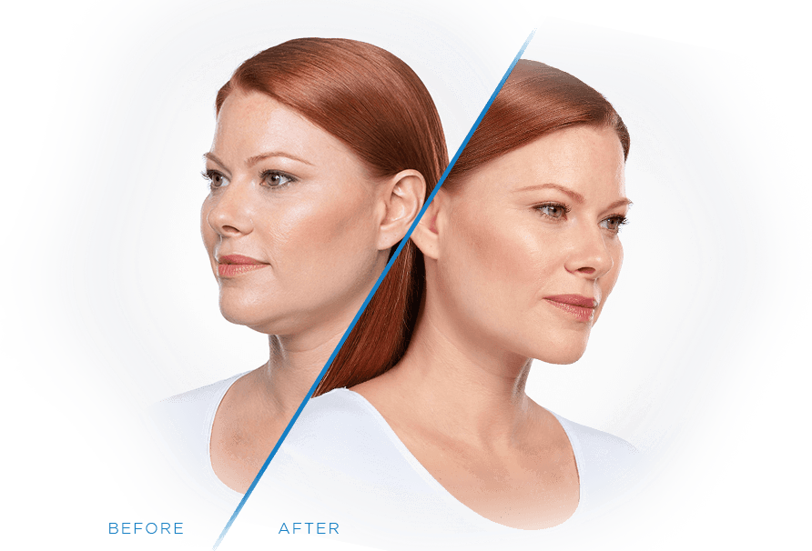 before after kybella 1 e1542213127753