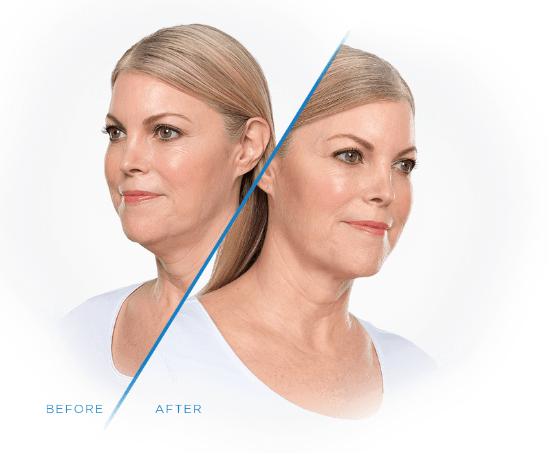 before after kybella 3