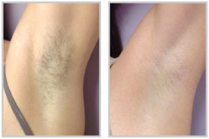 laser hair removal underarms before after 300x200