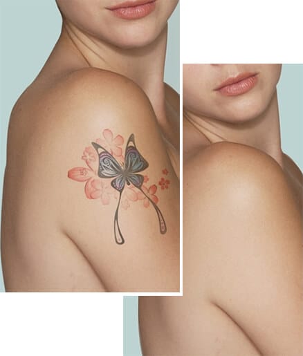 1764728945_tatto-removal Laser Tattoo Removal