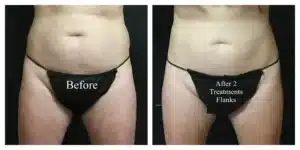 CoolSculpting®