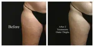 CoolSculpting®