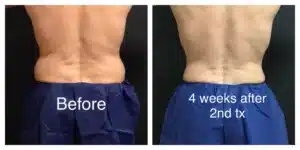 CoolSculpting®