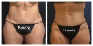 CoolSculpting®