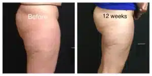 CoolSculpting®