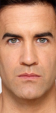 1764729403_Layer-63 Botox