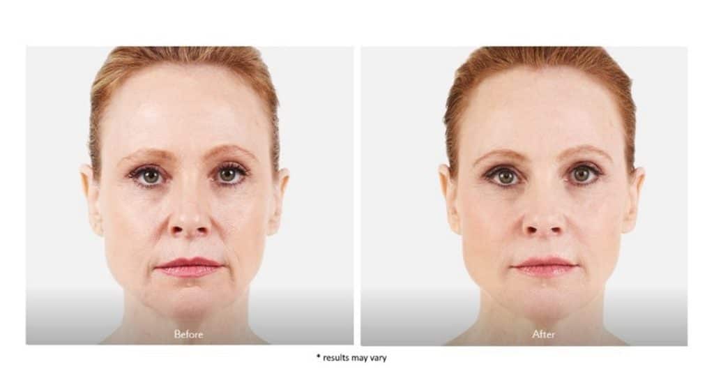 1764729434_Juvederm-AB-1-1024x532-1 Juvederm