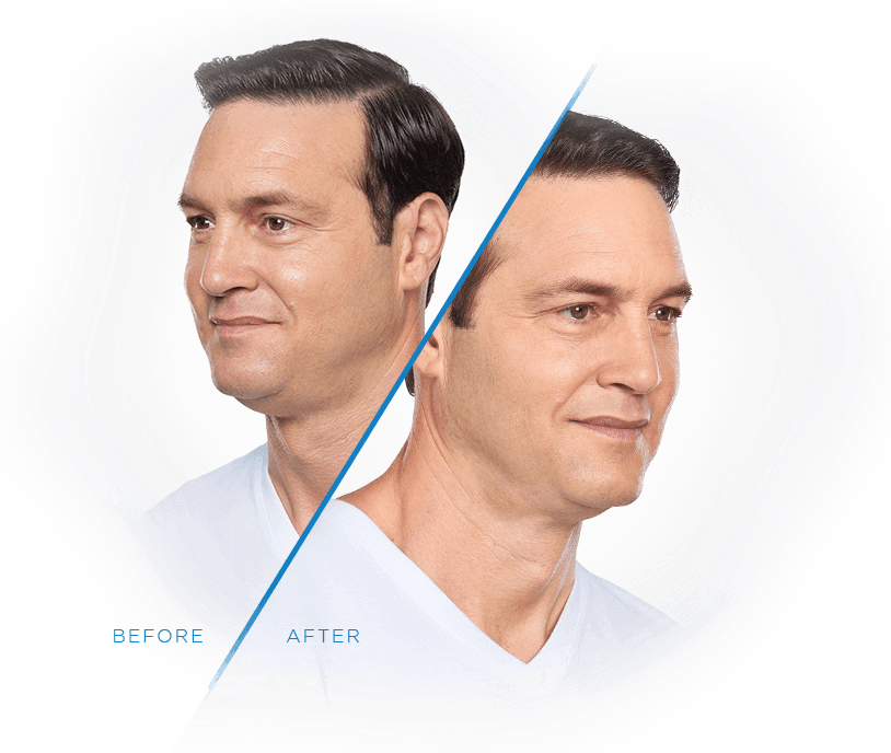 1764729459_before-after-kybella-2 Kybella