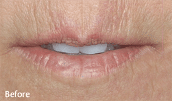 1764729485_Layer-70 Restylane