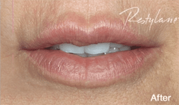 1764729493_Layer-71 Restylane