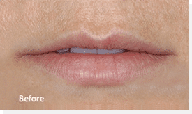 1764729500_Layer-73 Restylane