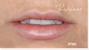 1764729506_Layer-74 Restylane