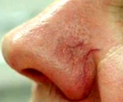 1764729530_Layer-97 Laser Vein Removal