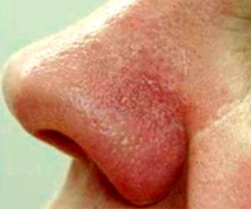 1764729536_Layer-98 Laser Vein Removal