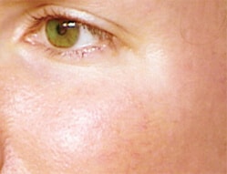 1764729549_Layer-100 Laser Vein Removal