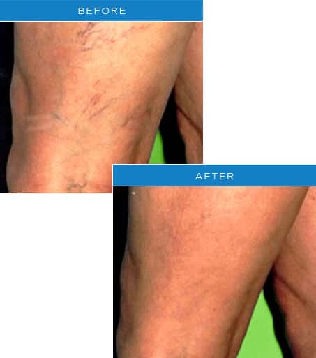 1764729555_BEFORE Laser Vein Removal