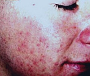 Laser Acne Removal