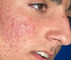 Laser Acne Removal