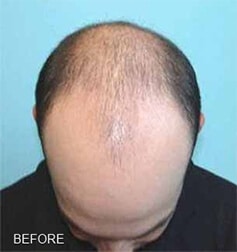 1764729815_Layer-81 Hair Replacement