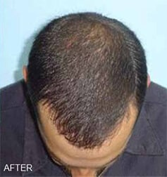 1764729820_Layer-80 Hair Replacement